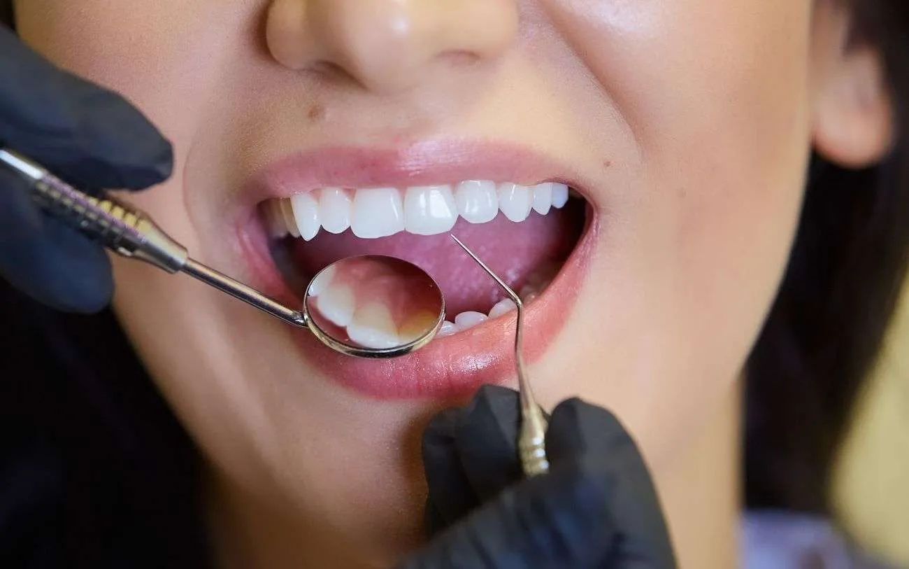 dental bonding hamilton on