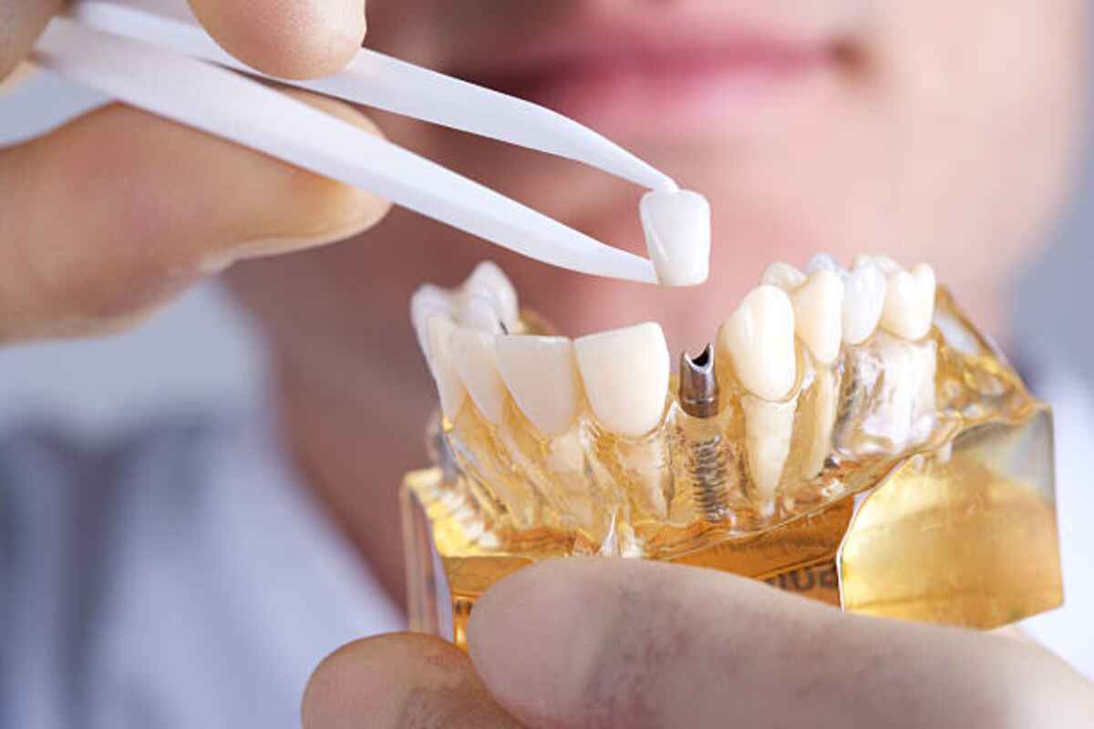 dental implants service in hamilton