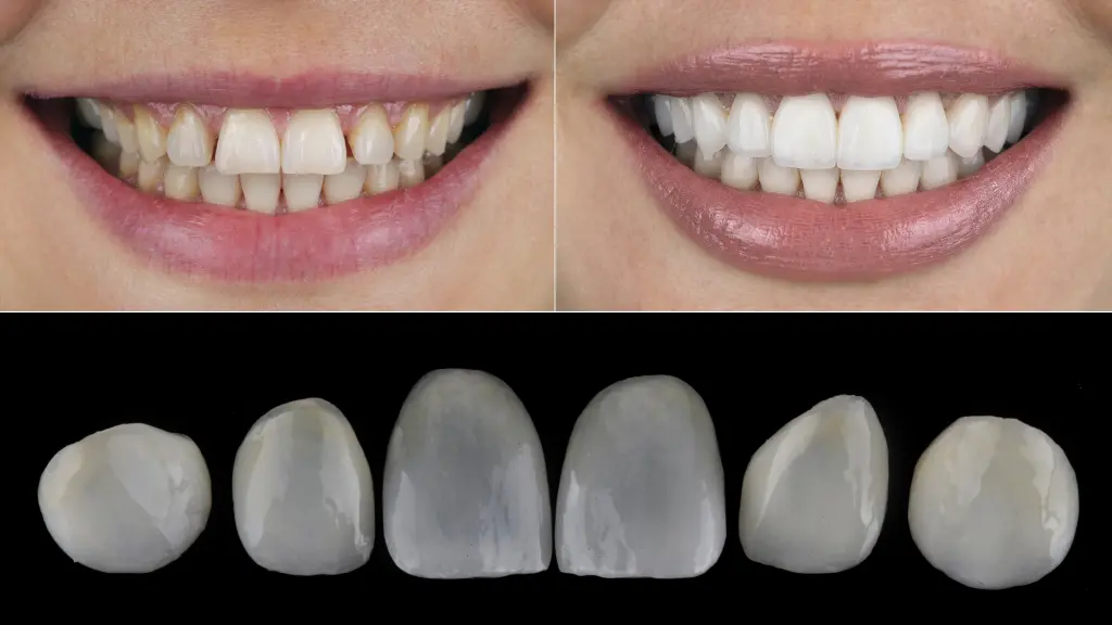 Dental Veneers in Hamilton