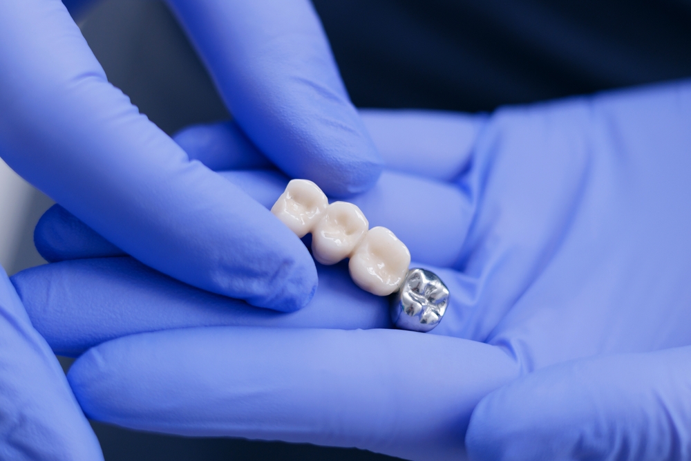 hamilton dental bridges