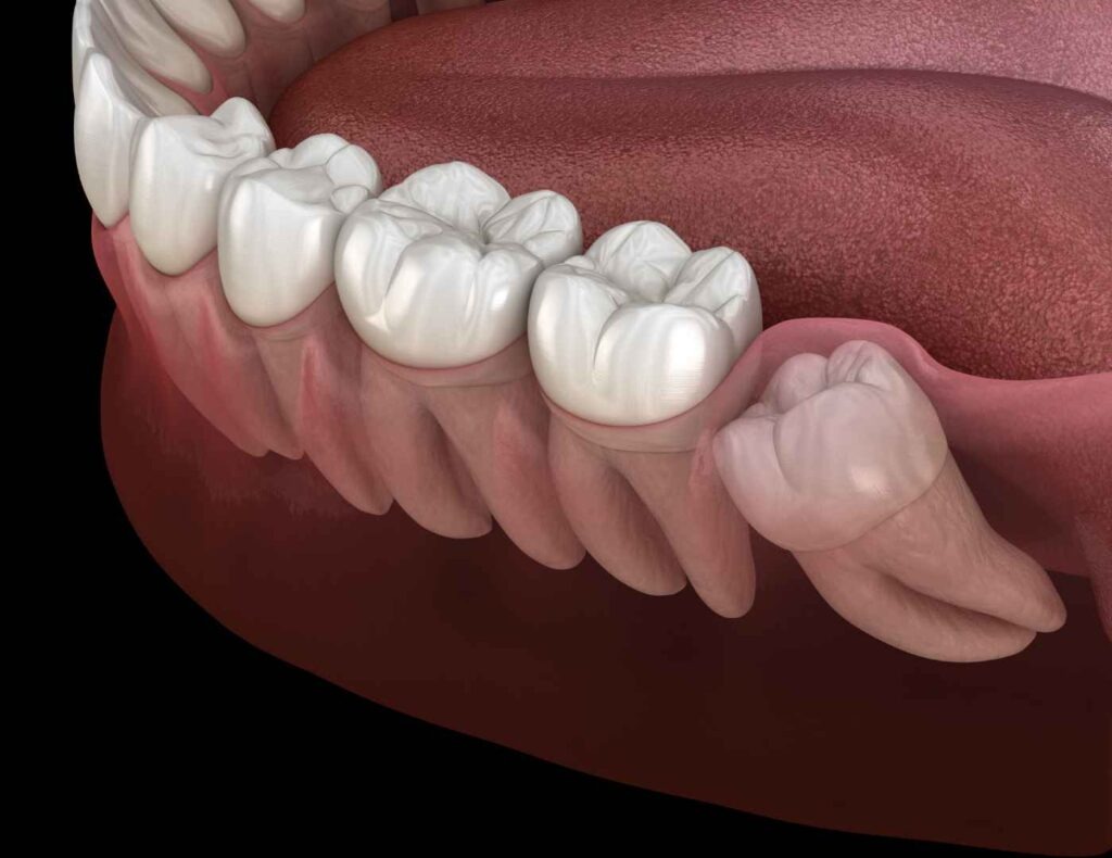 Can You Keep Your Wisdom Teeth?